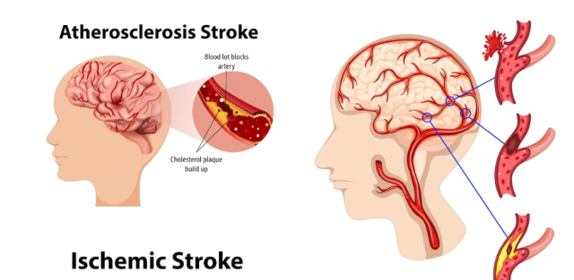 Ischemic Stroke